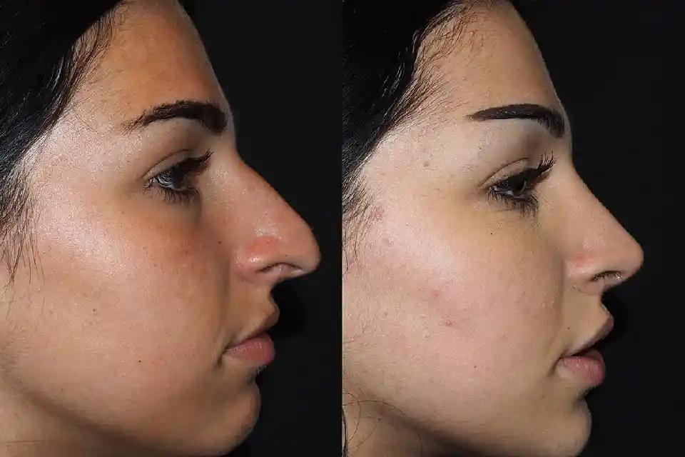 Rhinoplasty for Teens in Dubai: A Parent's Guide