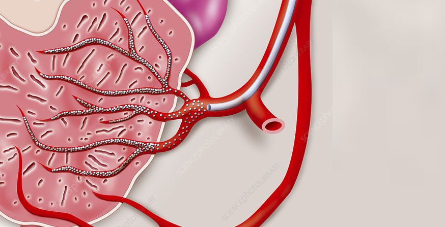 prostatic-artery-embolization