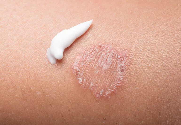 Topical Skin Infection Treatment MarketTopical Skin Infection Treatment Market