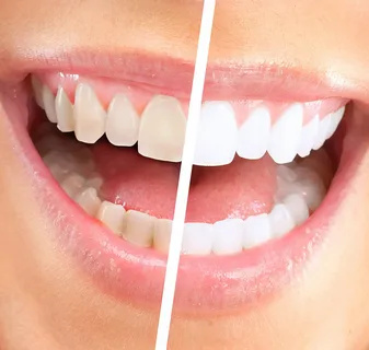 Teeth Whitening Cleveland