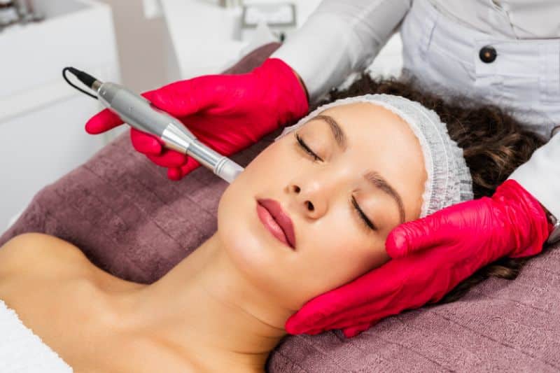 MicroNeedling Southampton