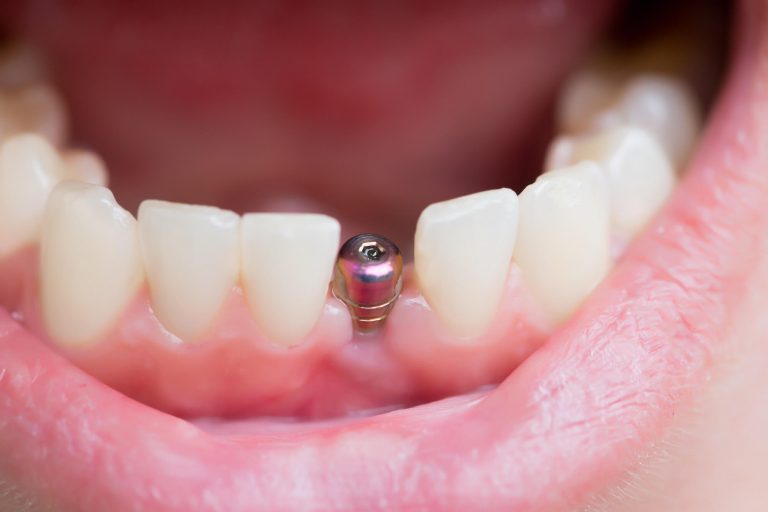 Tricks and Tips to Ensure Proper Care Of Dental Implant