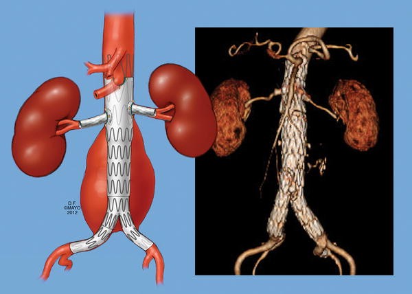 North America Aortic Stent Graft Market