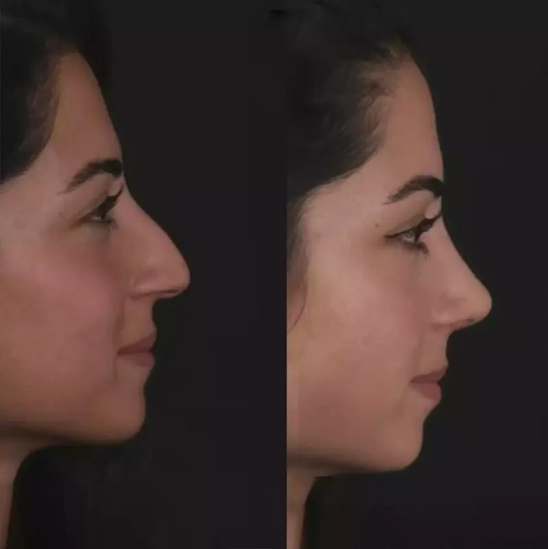 Your Guide to Septoplasty in Dubai for Nasal Blockage Relief